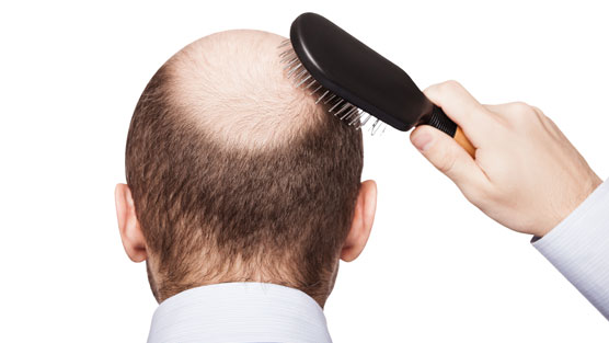Male-Pattern-Baldness-May-Indicate-An-Increased-Risk-For-Prostate-Cancer-Death