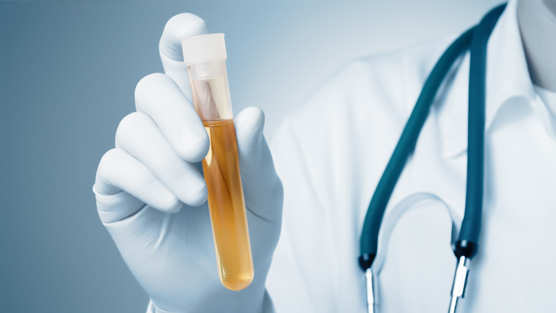 new-urine-test-could-be-more-accurate-in-diagnosing-prostate-cancer