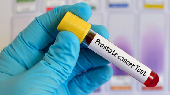 promising-new-prostate-cancer-tests-on-the-horizon-dr-david-samadi