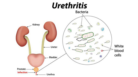 What Is Urethritis In Men?